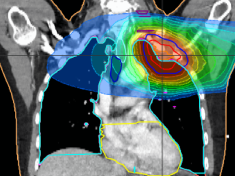 Best of QADS: Evaluating Clinical Workflow Changes Using Transit In Vivo Dosimetry